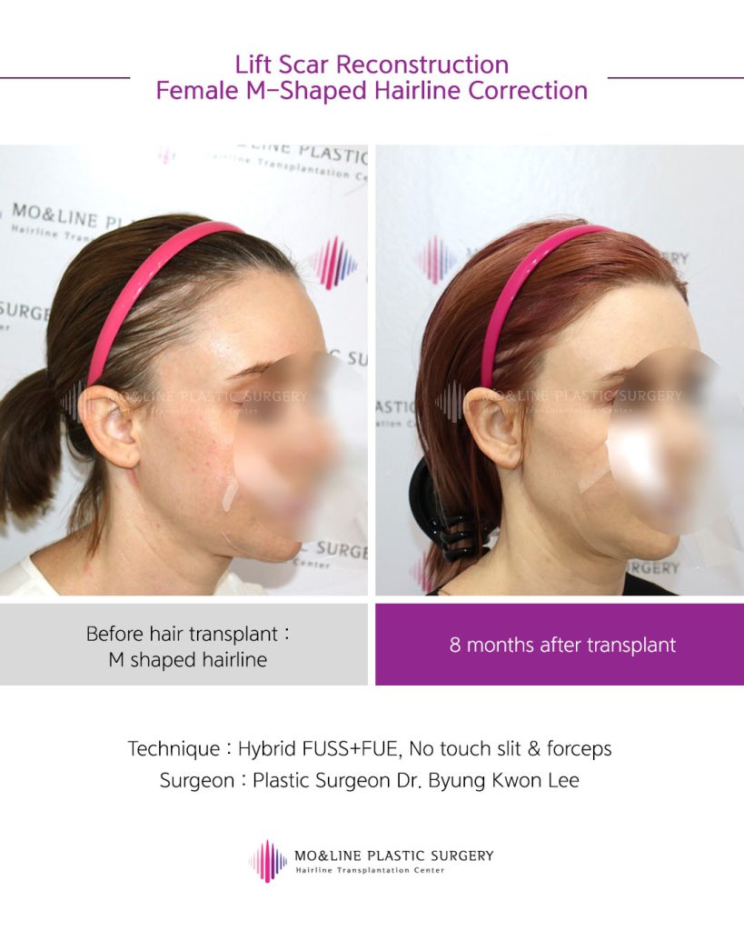 ENG elizabeth님 우측 전후사례