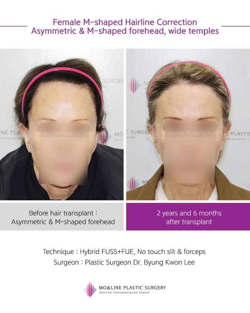 ENG patricia님 정면 전후사례