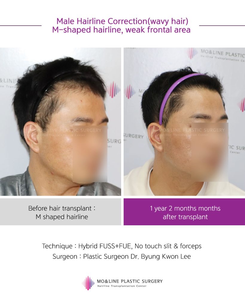 ENG 김학민님 우측 전후사례