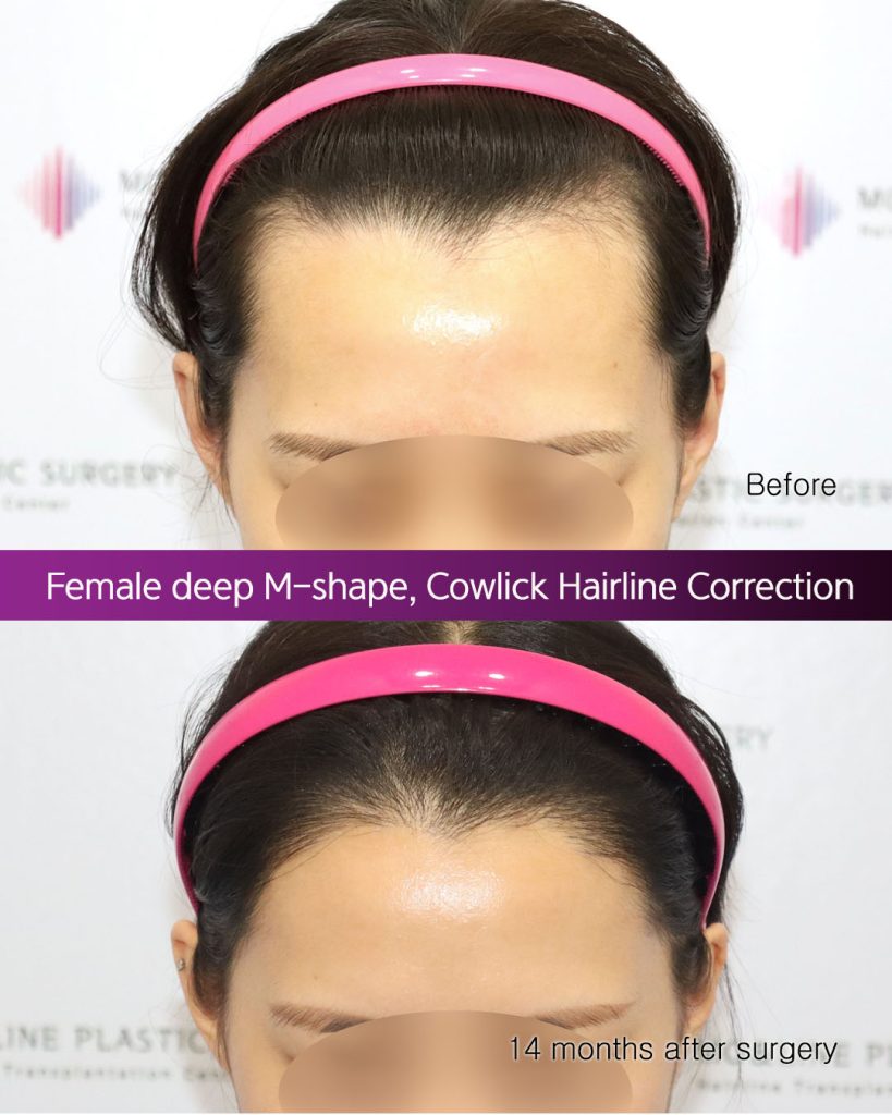 김지나님_여성 헤어라인 교정 ENG